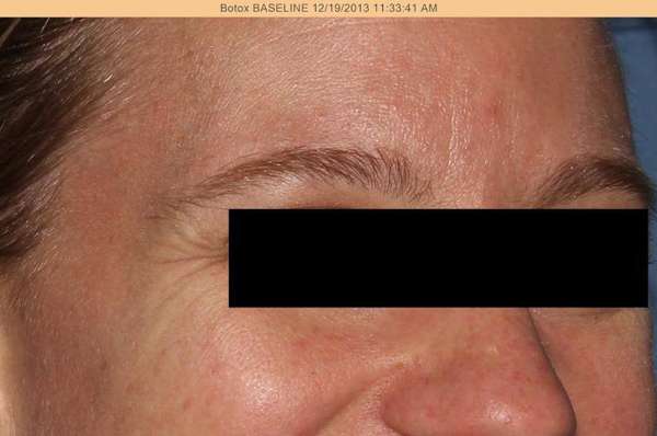 Botox® / Dysport®