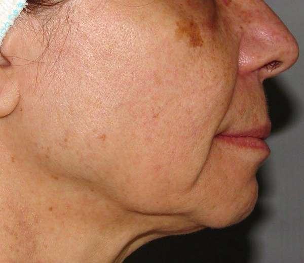 Microneedling