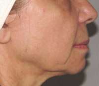 Microneedling