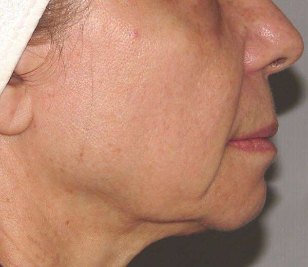 Microneedling