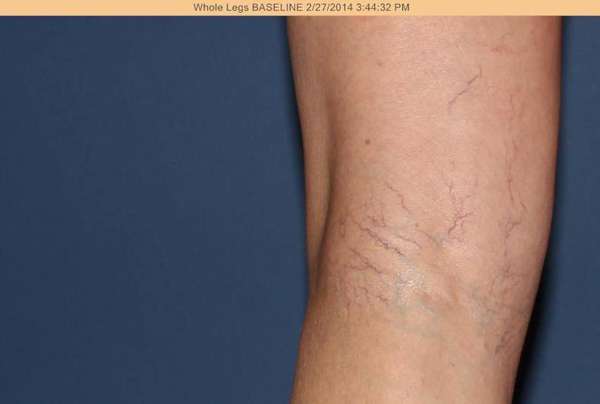 Spider Veins