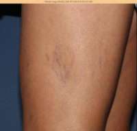 Spider Veins