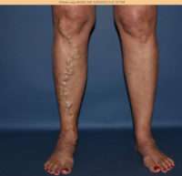 Varicose Veins