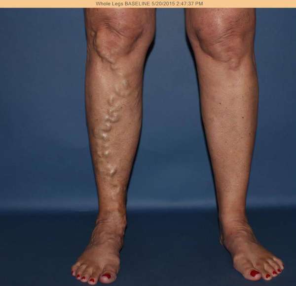 Varicose Veins