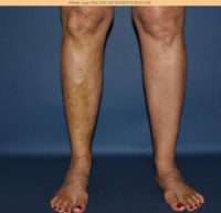 Varicose Veins