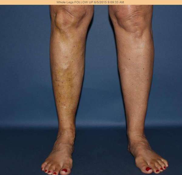 Varicose Veins
