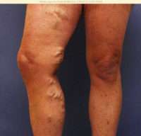Varicose Veins