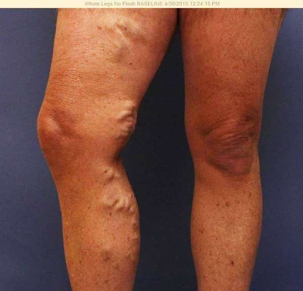 Varicose Veins