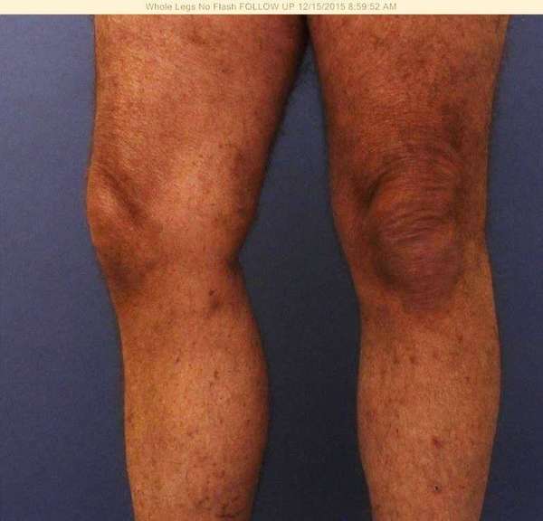 Varicose Veins