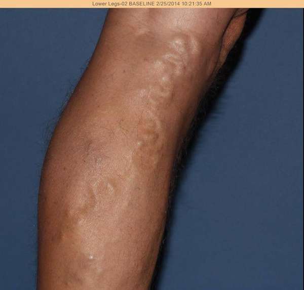 Varicose Veins