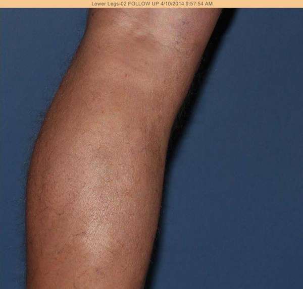 Varicose Veins