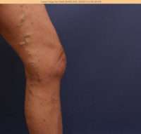 Varicose Veins