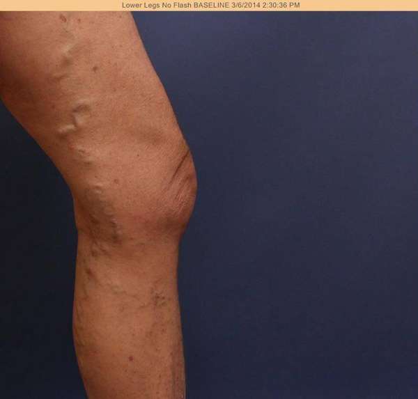 Varicose Veins