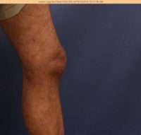 Varicose Veins