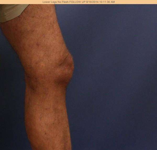 Varicose Veins
