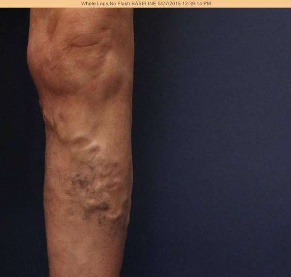 Varicose Veins
