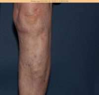 Varicose Veins