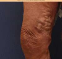 Varicose Veins