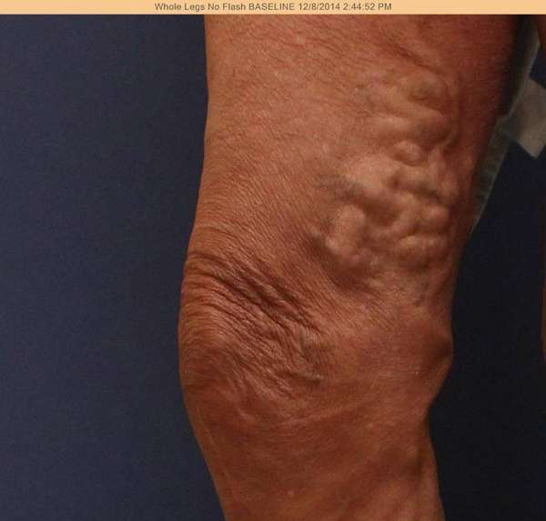 Varicose Veins