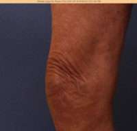 Varicose Veins