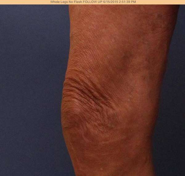Varicose Veins