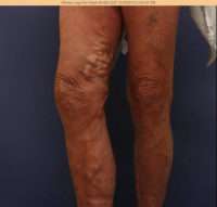 Varicose Veins