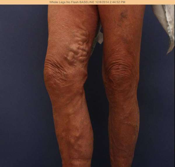 Varicose Veins