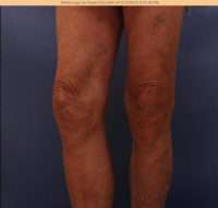 Varicose Veins