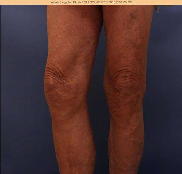 Varicose Veins