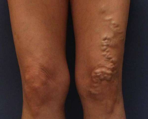 Varicose Veins