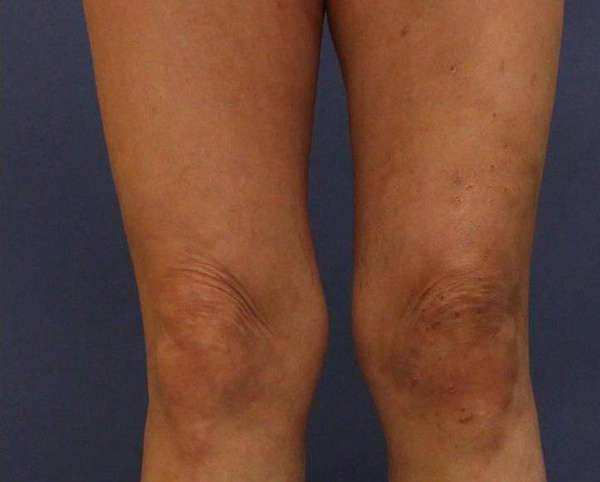 Varicose Veins
