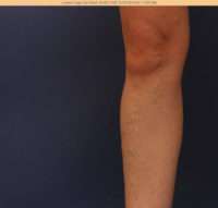 Varicose Veins