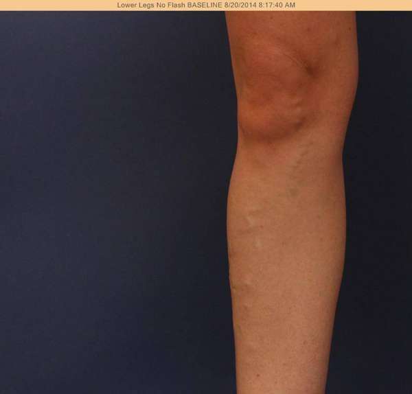 Varicose Veins