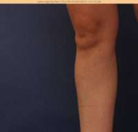 Varicose Veins