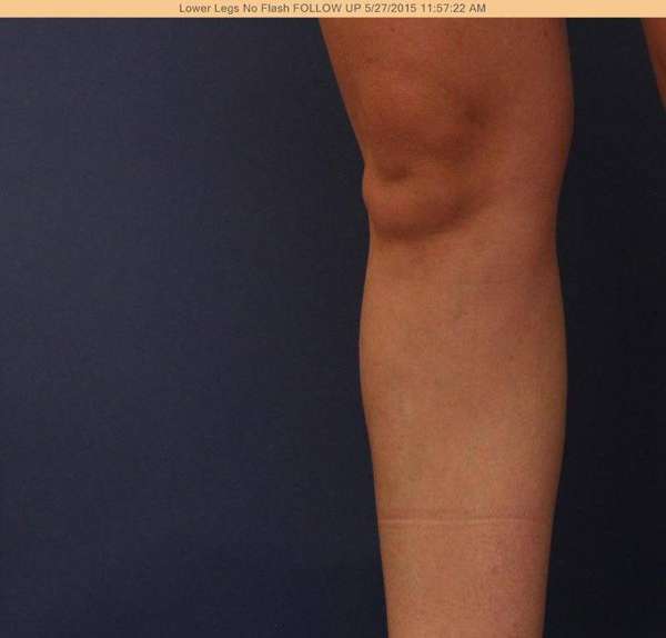 Varicose Veins