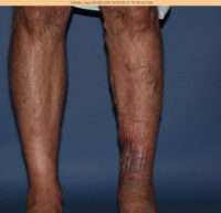 Varicose Veins