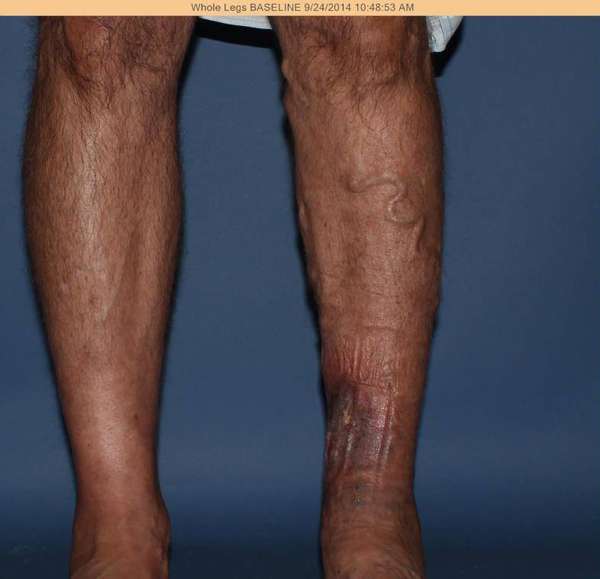 Varicose Veins