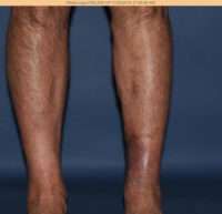 Varicose Veins