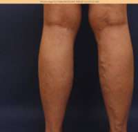 Varicose Veins