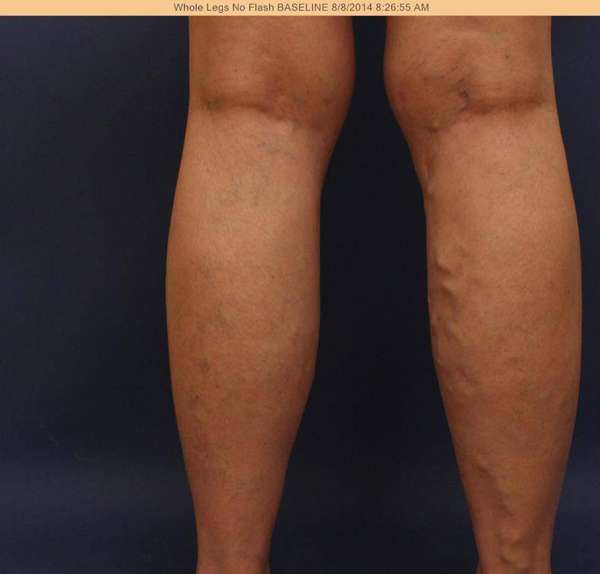 Varicose Veins