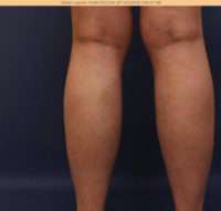 Varicose Veins