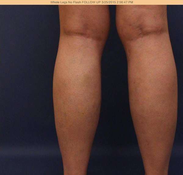Varicose Veins