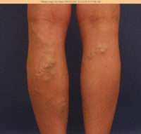 Varicose Veins