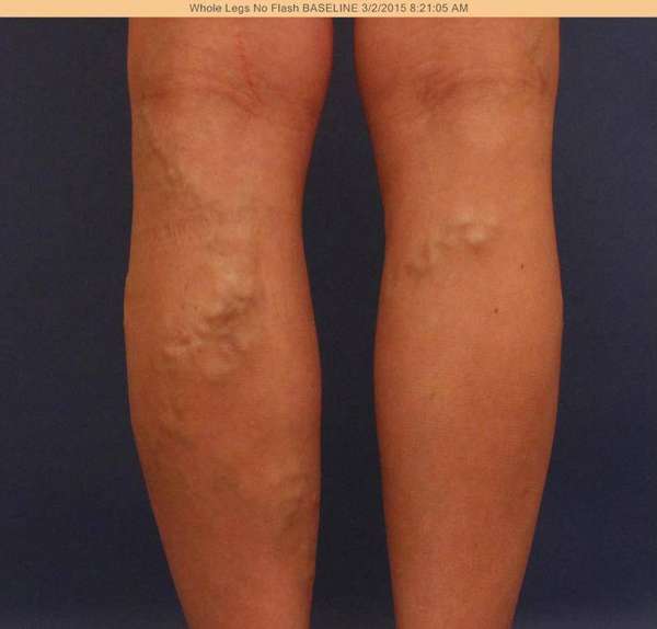 Varicose Veins