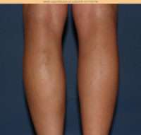 Varicose Veins