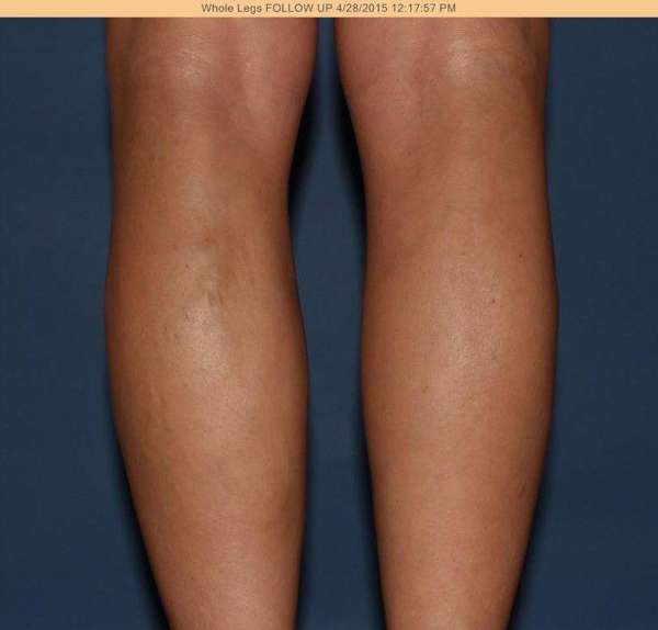 Varicose Veins