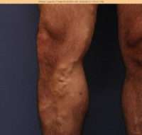 Varicose Veins