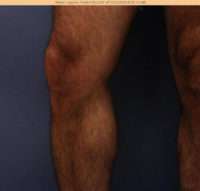 Varicose Veins