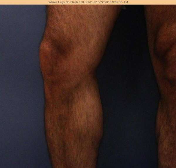 Varicose Veins