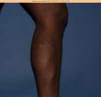 Varicose Veins